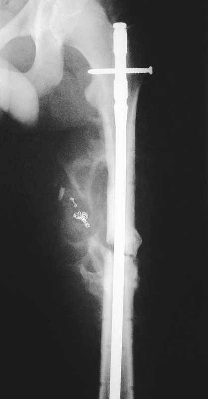 RTG obraz stavu po konverzi zevní fixace na nitrodřeňový hřeb, st.p. angiografickém řešení pseudoaneuryzmatu spirálami Vortex
Pic. 6. X-ray view of the condition following conversion of external fixation to intramedullary nailing, st.p.angiographic management of the pseudoaneurysm using Vortex spirals