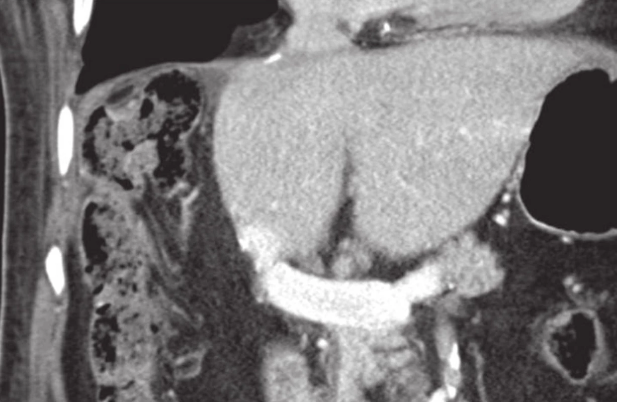 Stav po pravostranné hepatektomii, výrazný nárůst FLRV po PVE dx. s aplikací MSC
Fig. 5: Status post right-sided hepatectomy; distinct FLRV growth after PVE dx. with MSC application
