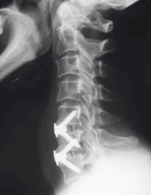 Pooperačný laterogram po implantácii klietky Zero-P VA<sup>®</sup> v segmentoch C5–C6 a C6–C7 (archív autora).
Fig. 1. Lateral X-ray image after Zero-P VA<sup>®</sup> cage implantation in segments C5–C6 and C6–C7 (author’s archive).