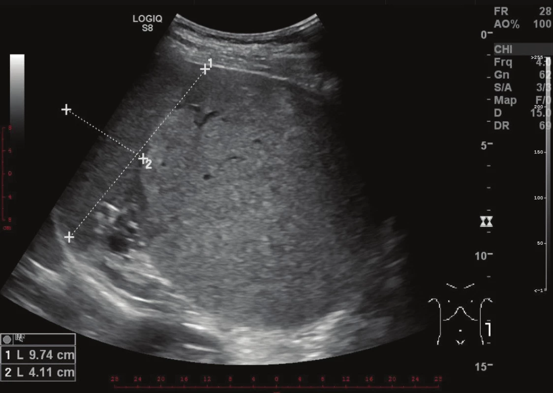 Zobrazení expanze levého hypochondria na ultrazvuku
Fig. 1: Ultrasound image of an expansion in the left hypochondrium