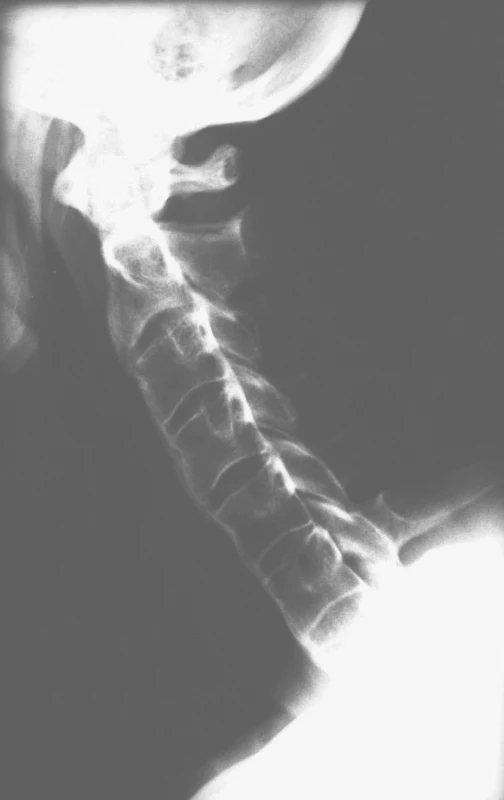 Krční páteř v bočné projekci: Postižení krční páteře při ankylozující spondylitidě. Těla obratlů jsou ventrálně remodelována přemosťujícími syndesmofyty.