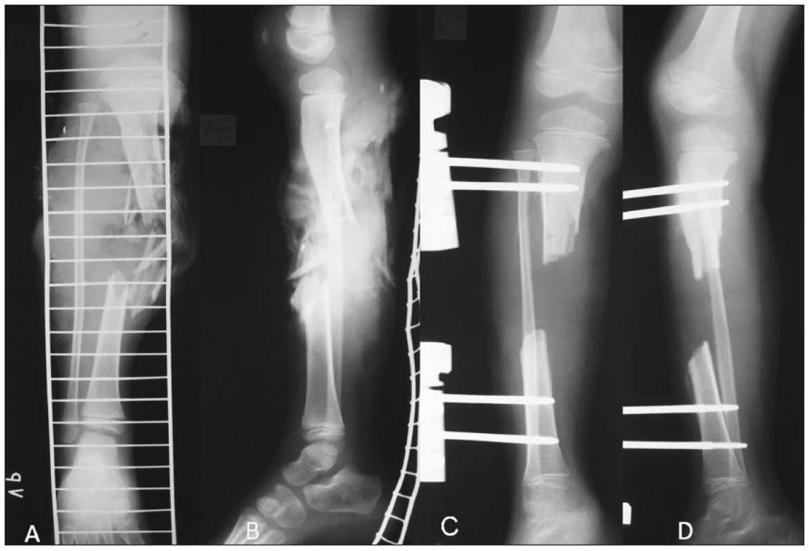 a. Tibial shaft fracture – PA view
b. Tibial shaft fracture – lateral view
c. Tibial defect after debridement and stabilization by unilateral external fixator – PA view
d. Tibial defect after debridement and stabilization by unilateral external fixator – lateral view