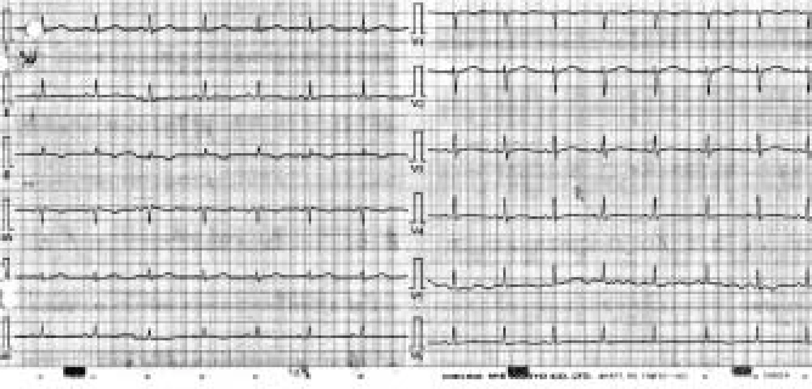 Normální korigovaný QT interval po vysazení medikace a normalizaci vnitřního prostředí.