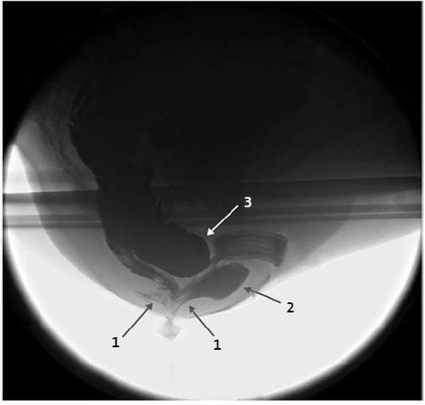 Intususcepce se silnou řasou prolapsu ventrálně i dorsálně (1), ventrálně oddělenou rektokélou (2) a se shora tlačící enterokélou (3).
Fig. 2. Intussusception with thick prolapsing fold at the ventral and dorsal side (1), at the ventral sides separates by rectocele (2) and top-down compressed by enterecele (3).