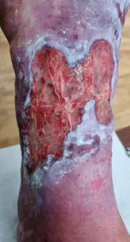 Levý bérec po dvou měsících léčby Xarelto a Vessel Due F, lokálně biokeramické krytí Cerdak.