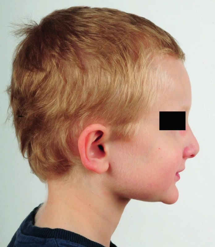 a, b. Pětiletý pacient s Alagilleovým syndromem a typickou kraniofaciální dysmorfií – prominujicí čelo, vpadlé oči a ostrá brada.
Fig. 1a, b. A 5-year-old patient with Alagille syndrome and typical facial features – a prominent forehead, deep-set eyes and a pointed chin.