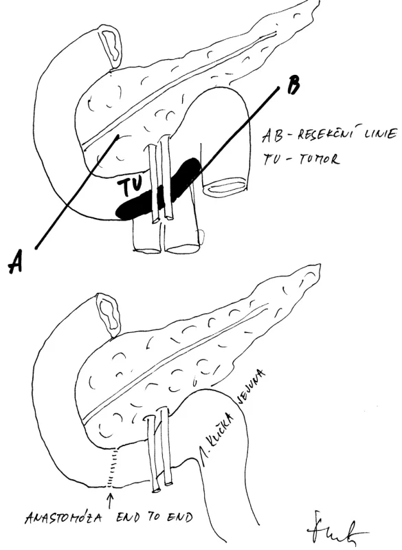 Přímá end to end anastomóza retrokolicky protaženou kličkou jejuna mezi dvanáctníkem a jejunem
Fig. 5: Direct, end-to-end retromesenteric connection between the duodenum and the jejunum, through the jejunal loop