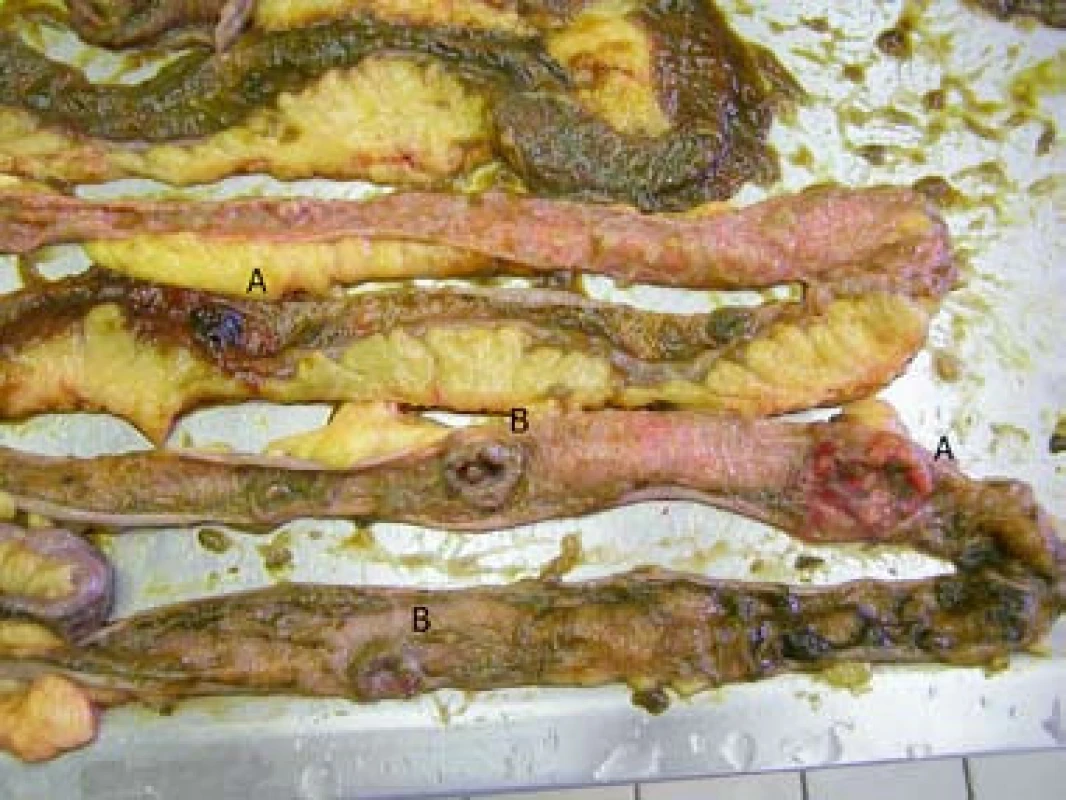 Mnohočetné melanotické (A) i amelanotické (B) metastázy jejuna.
Fig. 4. Multi-metastatic involvement of jejunum – melanotic (A) and amelanotic (B) metastases.