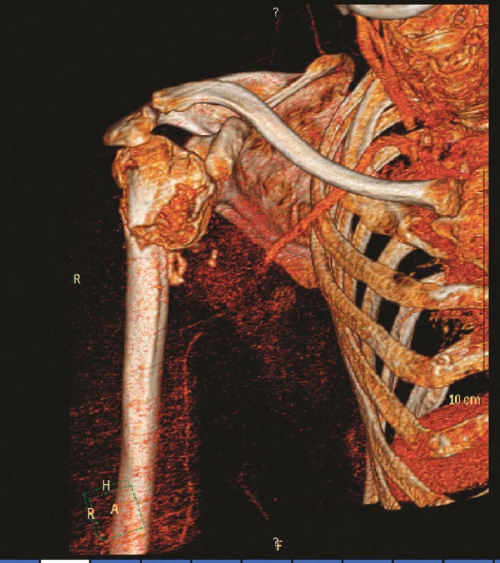 3D CT angiografie s patrnou okluzí 3. segmentu arteria axillaris
Fig. 1. 3D CT angiography depicting occlusion of the 3rd segment of the arteria axillaris