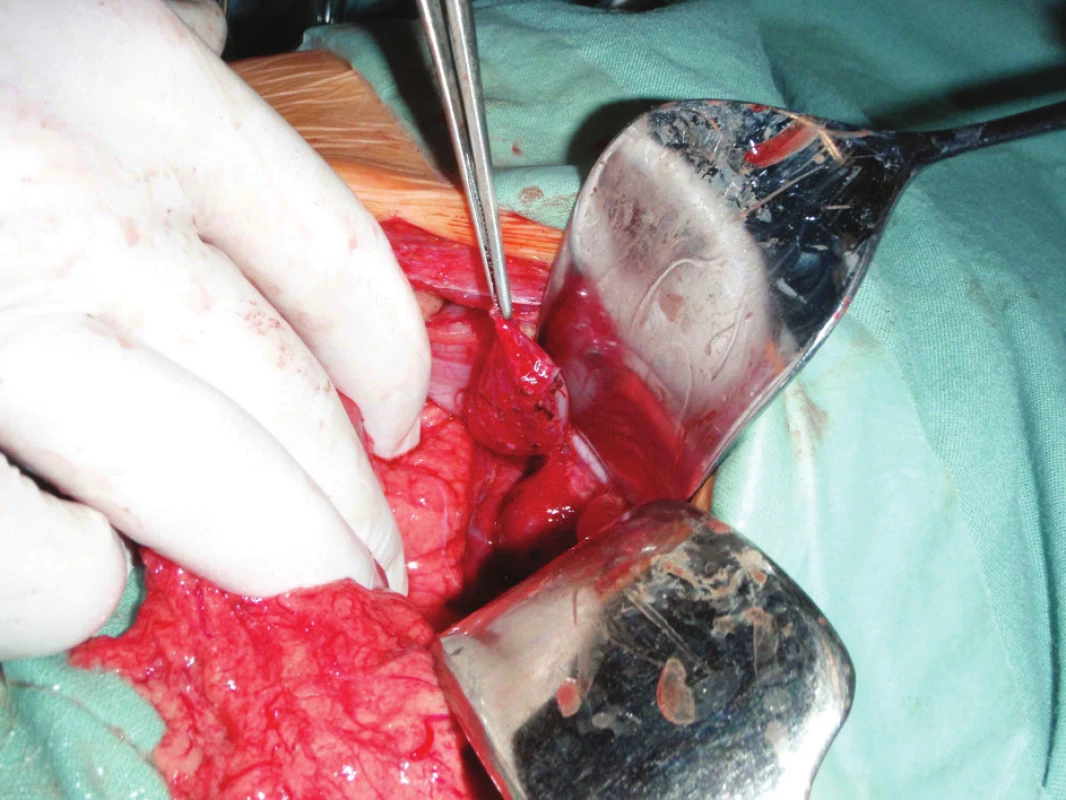 Operace, exstirpace cysty
Fig. 4: Surgery, exstirpation of the cyst