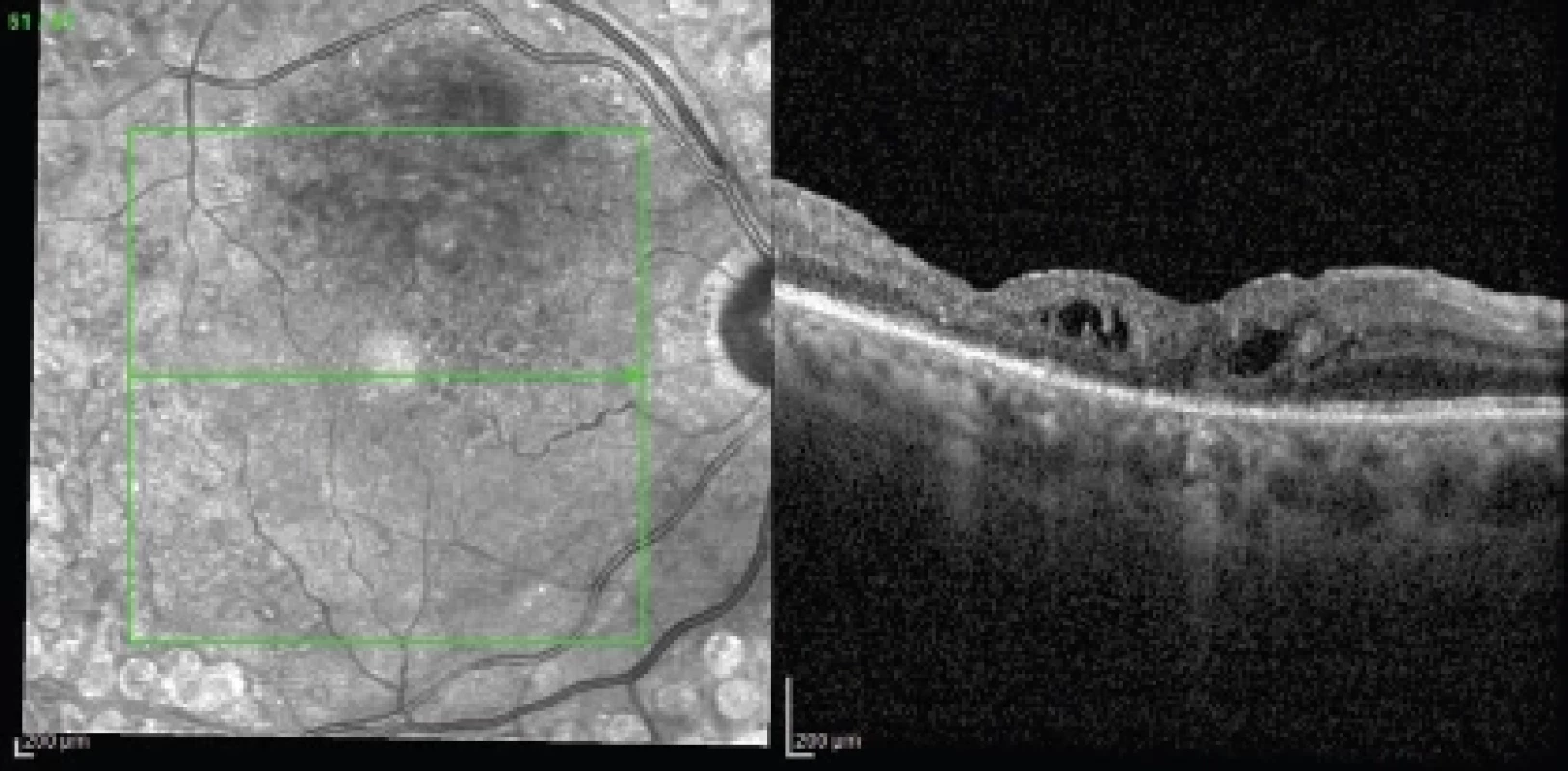 Atrophic diabetic maculopathy