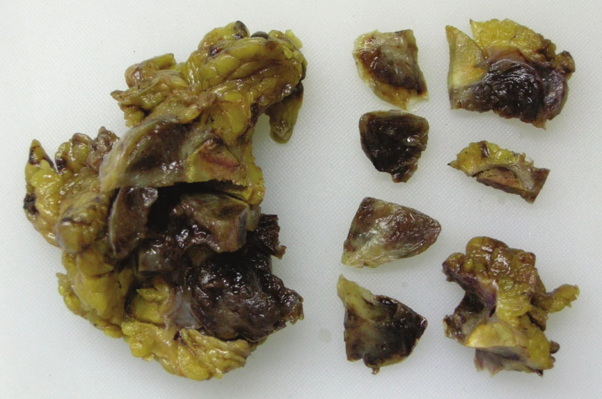 Makroskopický obraz resekátu prokrájený patologem
Fig. 2: Macroscopic image of EGIST resecate