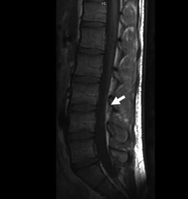 Kontrola MR po 12 dnech ATB.
Fig. 4. Follow-up MR after 12 days of ATB.
