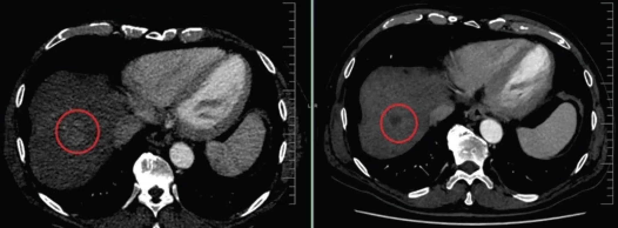 CT vyšetření. Vlevo hyperdenzní ložisko HCC subdiafragmaticky, vpravo absence sycení po úspěšné terapii. Zdroj: archiv Radiodiagnostického oddělení. Fig. 􀍹. CT examination. On the left, a hyperdense HCC lesion located subdiaphragmatically; on the right, absence of enhancement after successful therapy. Source: archive of Department of Radiodiagnostic.