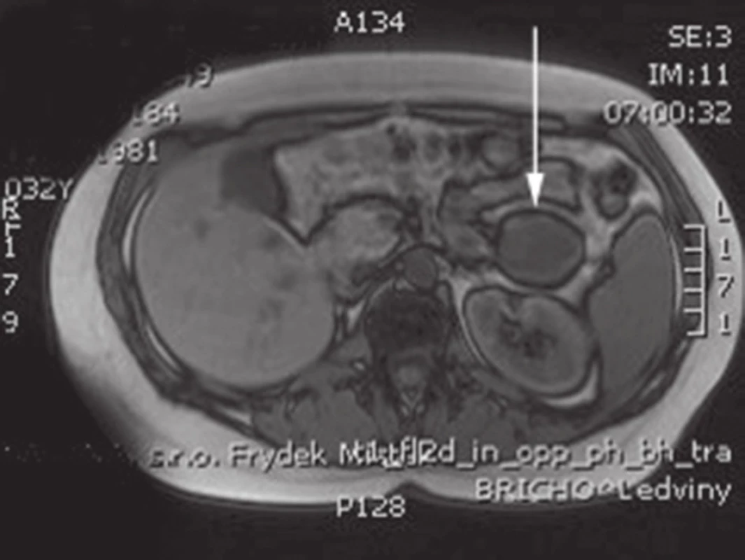 MRI s nálezem SPN v oblasti kaudy pankreatu
Fig. 2: Abdominal MRI with the finding of SPN of the pancreatic tail