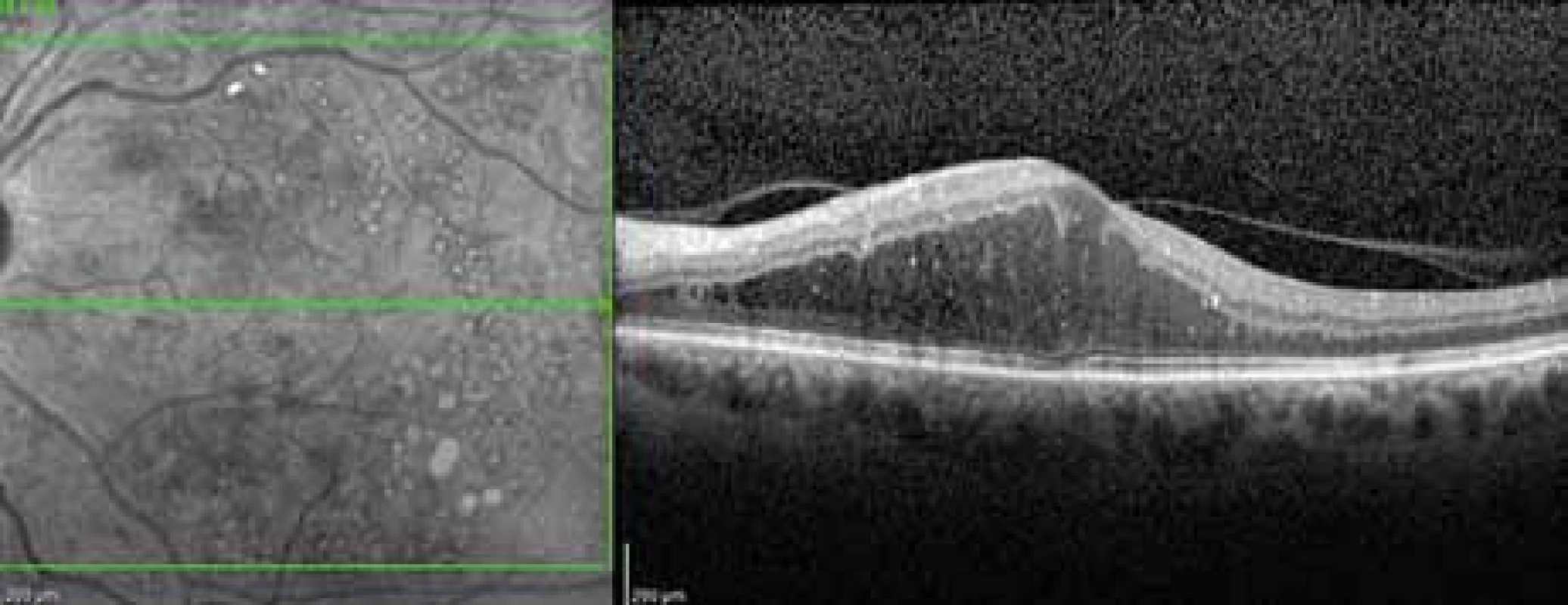 OCT obraz (Spectralis OCT; Heidelberg Engineering) difuzního až cystoidního diabetického makulárního edému levého oka, na černobílém obrázku patrny laserové jizvy v makule, na horizontálním řezu sítnice je zachycena částečně odloučená zadní plocha sklivce, která adheruje k vrcholu edému a k papile zrakového nervu. Nález vhodný k aplikaci inhibitorů růstových faktorů do nitra oka.
