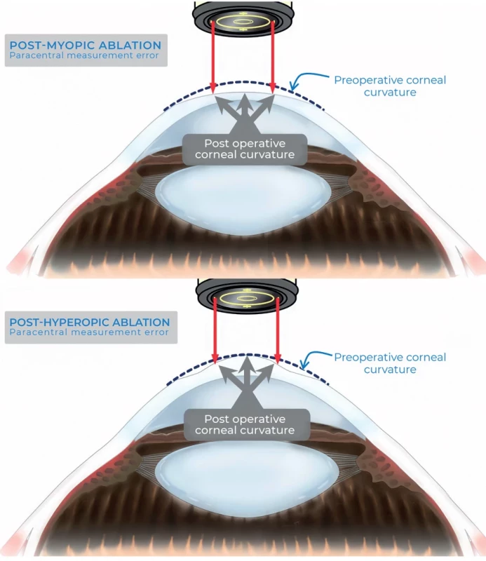 After myopic ablation, the paracentral measurement will overestimate central corneal power (top), and, after hyperopic ablation, it will underestimate central corneal power (bottom)
