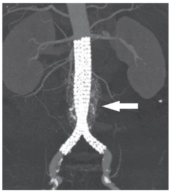 CT angiografie po implantaci
Fig. 3: Post-implant CT angiography
