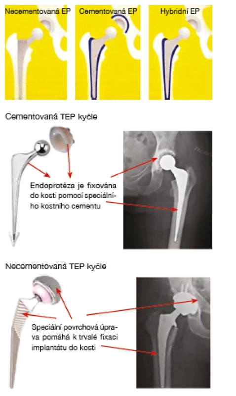 Typy endoprotéz dle fixace