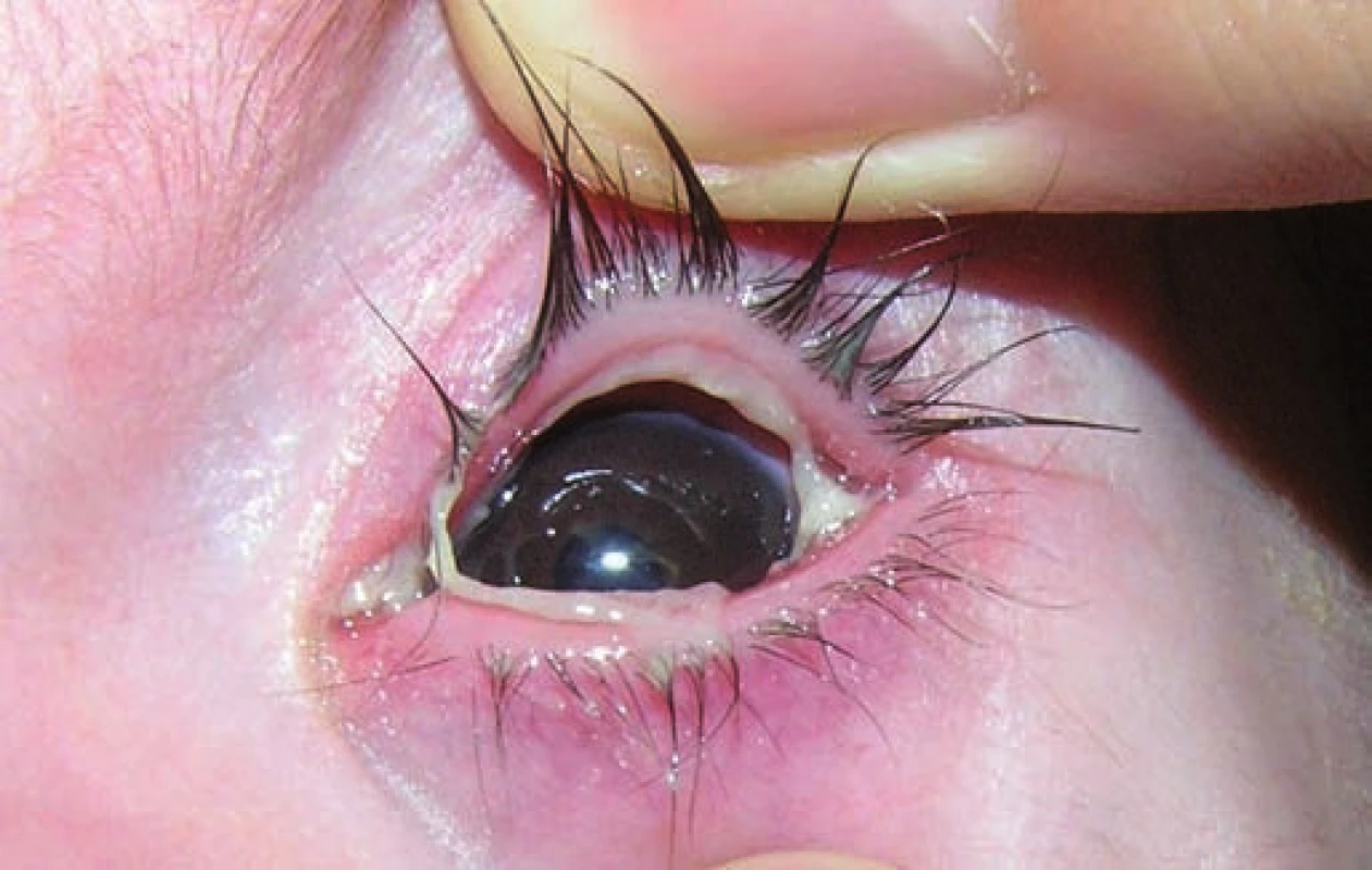 Ligneózna konjunktivitída.
Fig. 3. Ligneous conjunctivitis.