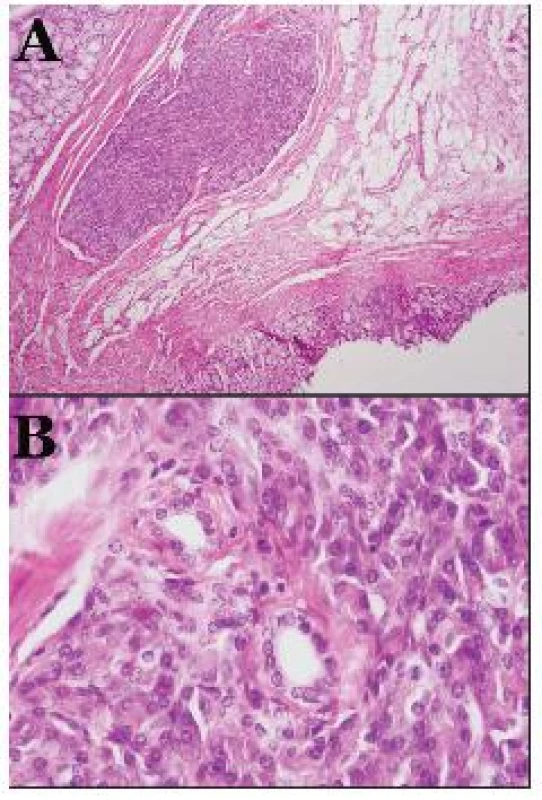 Histologický obraz heterotopického pankreasu (A – ložisko heterotopického pankreasu v submukóze (hematoxilin-eozín, 40x); B – malé pankreatické vývody (hematoxilin-eozín, 400x)
Obr. 3. Histological picture of heterotopic pancreas (A – lesion of heterotopic pancreasu in submucous (hematoxilin-eosin, 40x); B – little pancreatic dusts (hematoxilin-eosin, 400x)