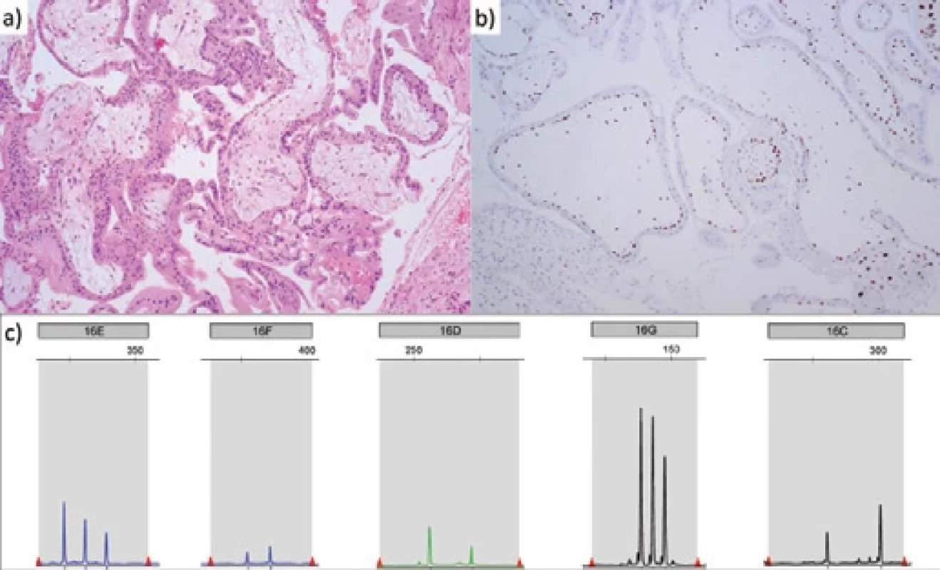 Histopathological, immunohistochemical and genetic fi ndings.  Obr. 1. Histopatologické, imunohistochemické a genetické nálezy.
