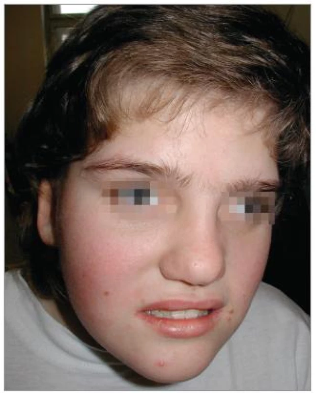 Kraniofaciální dysmorfie. Brachycefalie, hypoplazie střední obličejové části, prominující brada.