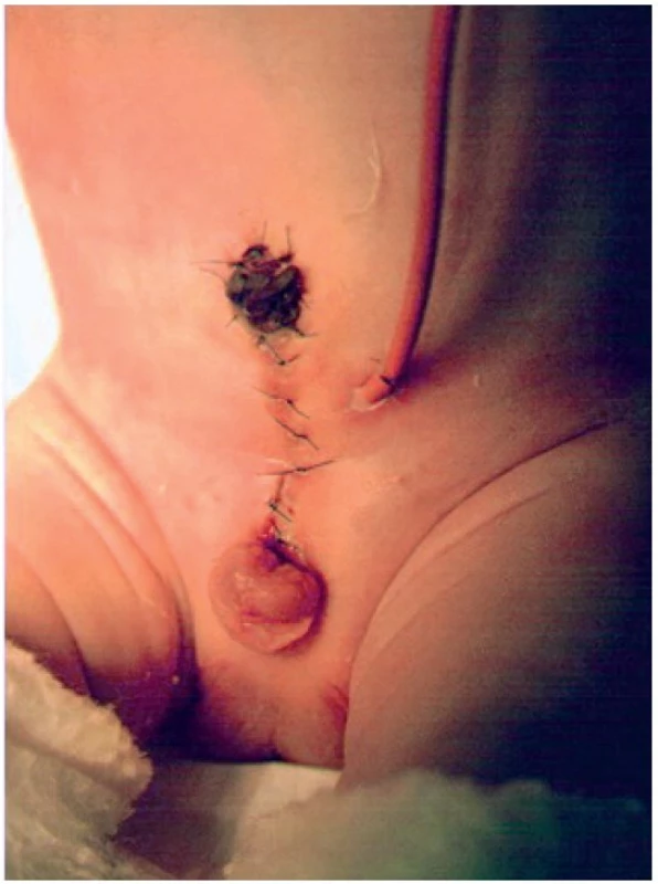 Po rekonstrukci měchýře a břišní stěny s ponecháním epispadické uretry.
Fig. 2. After reconstruction of the bladder with epispadias left.