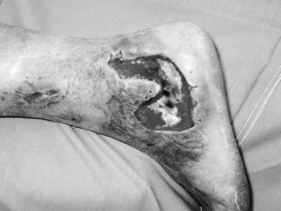 Pacient s defektem měkkých tkání po laterálním přístupu na zlomeninu patní kosti
Pic. 1. The patient with a soft tissue defect after a lateral approach procedure for his calcaneal fracure