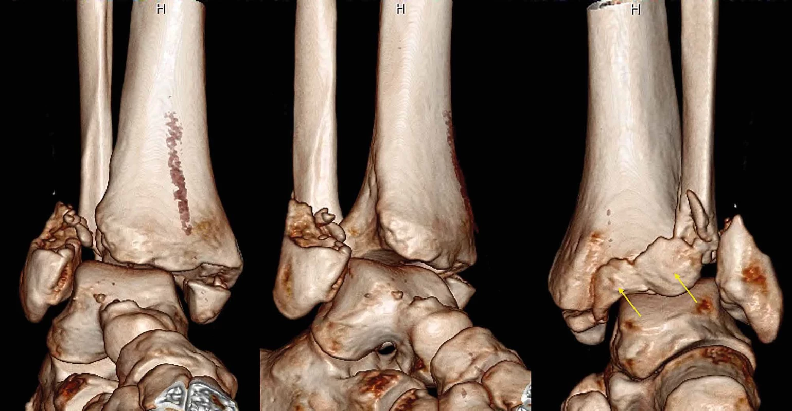 3D CT rekonstrukce Bosworthovy zlomeniny </br> 3D CT reconstruction of Bosworth fracture