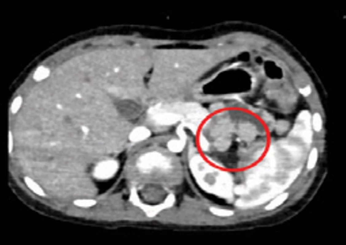 Absence kaudy pankreatu. Fig.2 . Absence of the pancreatic tail.