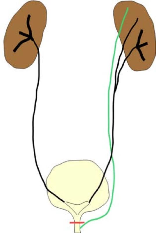 <i>Ureter triplex, ektopické, sub-sfinkterické vyústenie močovodu horného segmentu vľavo</i>
Fig. 6. <i>Ureter triplex, ectopic, sub-sphincteric position of the left ureter of the upper segment</i>