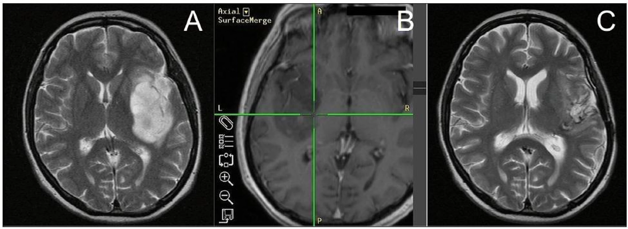 A. MR-T2 vážený obraz 52leté pacientky (N.2) s inzulárním AA (Yaşargil 3A) před operací.
B. MR-T1 vážený obraz intraoperativní navigace zobrazující dosažení mediálního okraje nádoru.
C. MR-T2 vážený obraz stejné pacientky 18 měsíců po operaci a dokončené adjuvantní chemoradioterapii (na časné MR po operaci 94% radikalita resekce).