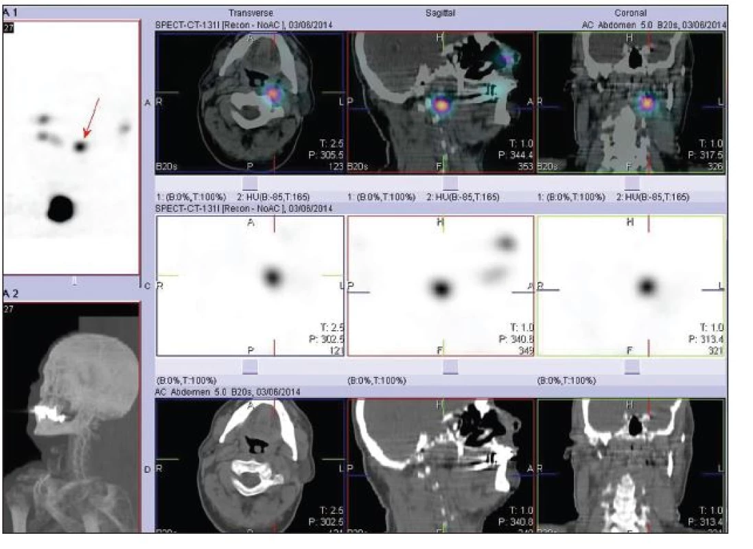 SPECT/low dose CT krku po terapii <b>7,4 GBq <sup>131</sup>I</b> s výrazně kontrastní depozicí <b>radiojódu</b> parafaryngeálně vlevo v úrovni C1/C2 odpovídající uzlinové krční metastáze.