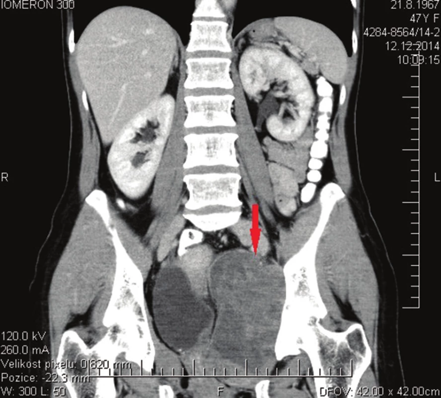 CT vyšetření v době stanovení diagnózy
Fig. 1: CT scan at the time of diagnosis