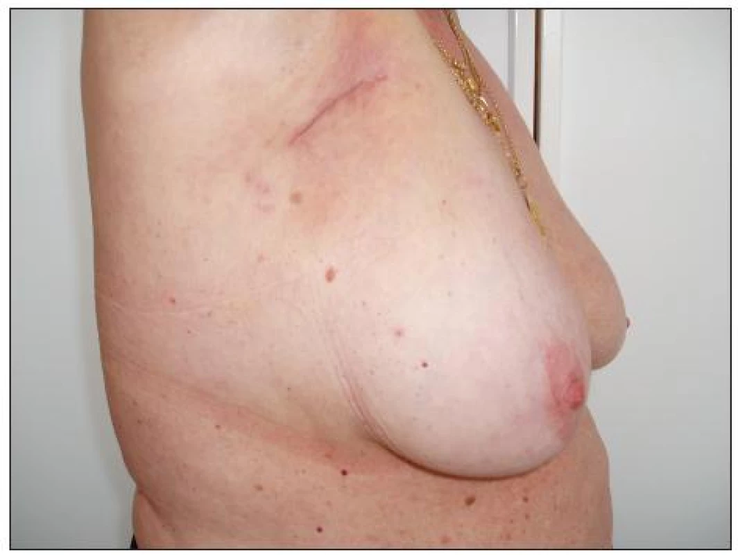 Stav po exenteraci pravé axily
Fig. 13. The condition following the right axilla exenteration