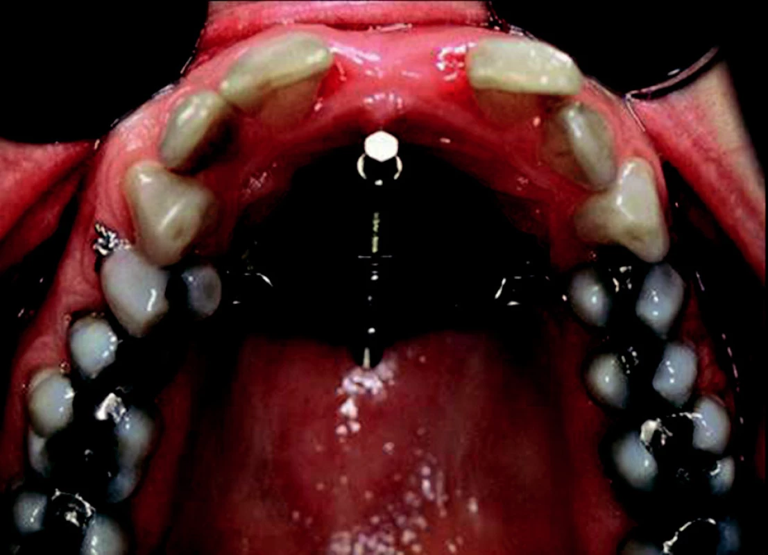 The Rotterdam Palatal Distractor (RPD), a bone-borne distractor for widening the narrow maxilla