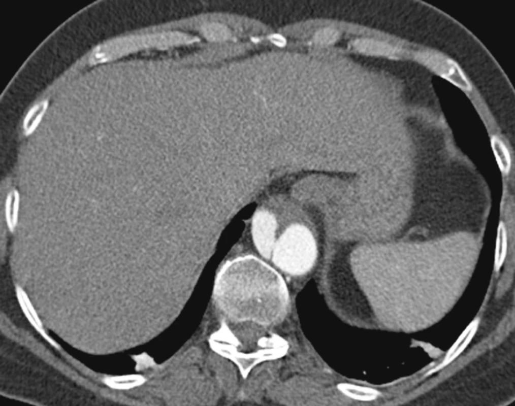 CTA po 1,5 roce s nálezem disekce šířící se od dolního okraje hrudního stentgraftu na břišní aortu
Pic. 9. A CTA view 1.5 years later with a finding of dissection located between the distal part of the thoracic stentgraft and the abdominal aorta