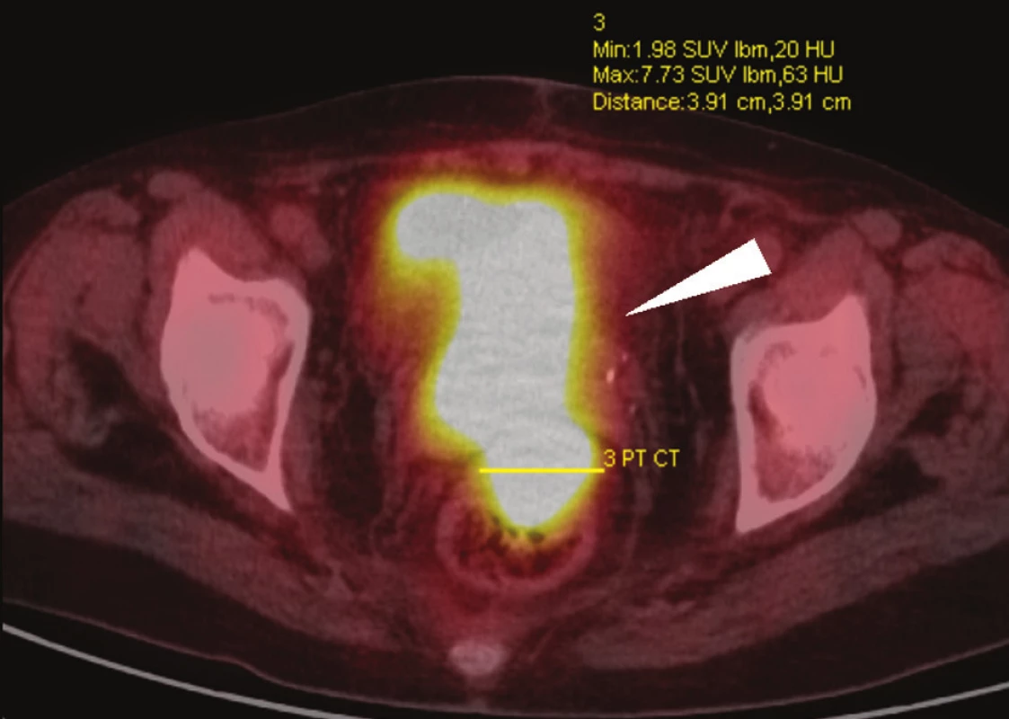 PET/CT vyšetření, axiální skeny: rozsáhlý tumor malé pánve, postihující rektum, pochvu a močový měchýř (bílá šipka) – vyšetření u stejné nemocné jako na Obr. 2.
Fig. 4: PET/CT, axial scans: advanced tumour of the small pelvis, invading the rectum, vagina and urinary bladder (white arrow) – findings in the same patient as shown in Fig. 2.
