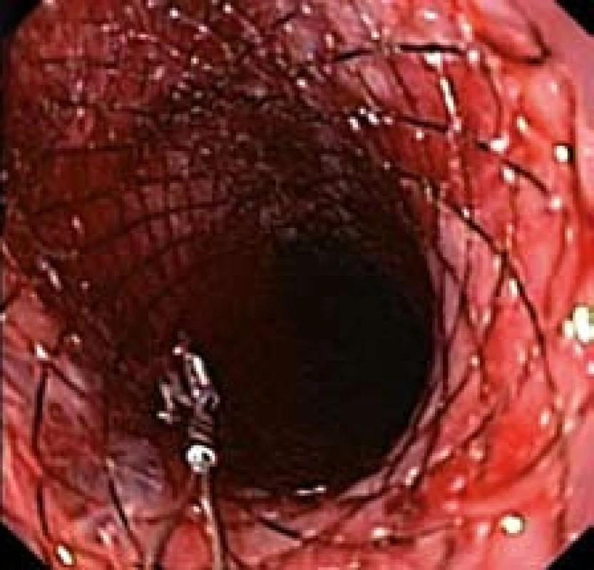 Proximální konec stentu po zavedení do jícnu (endoskopický obraz).
Fig. 9. Proximal end of the stent after application into oesophagus (endoscopic picture).