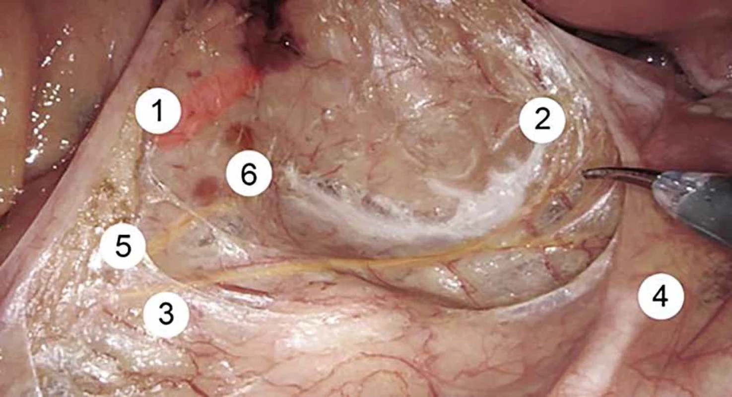 Pohled do pánve, začátek disekce mezorekta, roboticky asistovaná operace </br>  Fig. 1: Pelvic view, beginning of mesorectal dissection, robot-assisted surgery
