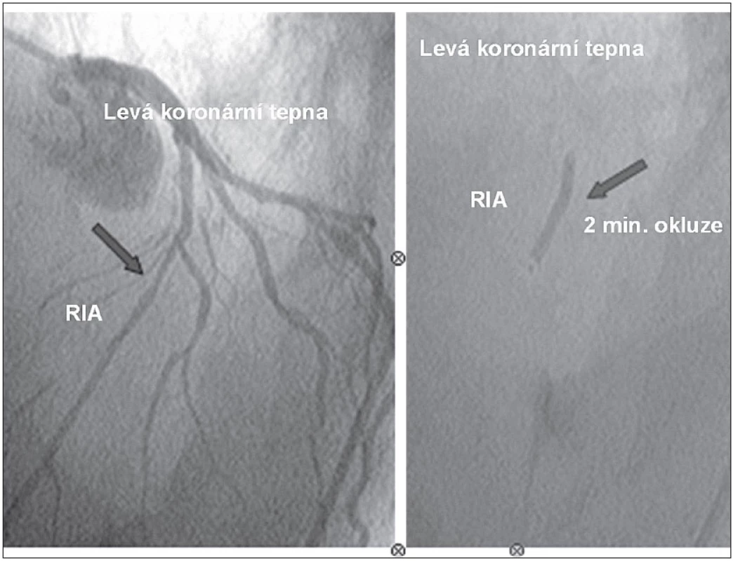 Intrakoronární implantace kmenových buněk do ramus interventrikularis anterior (RIA) metodou „over the wire PCI“ katétrem s balónkem o průměru 3,5 mm. Aplikace 5 ml buněčného koncentrátu během 2minutové okluze tepny.