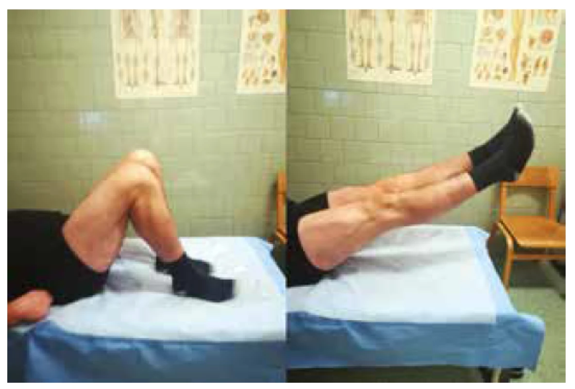 Rozsah pohybu oboch kolien u pacienta 1 rok po
operačnej liečbe bilaterálnej ruptúry ligamentum patellae<br>
Fig. 5: Range of motion of the both knees 1 year after surgical
treatment of bilateral patellar tendon rupture
