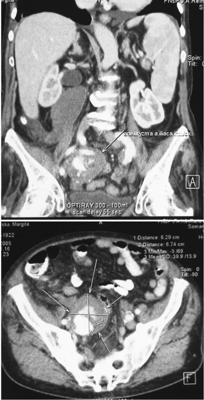 a, b. Pacient č. 1. CT obraz izolovanej aneuryzmy a. iliaca interna vpravo s hematómom v retroperitoneu siahajúcim až po obličku, prítomná hepatosplenomegália
Pic. 1a, b. Patient Nr. 1: A CT scan of an isolated aneurysm of the internal iliac artery on the right with retroperitoneal hematoma, spreading perirenaly.Hepatosplenomegaly is detected