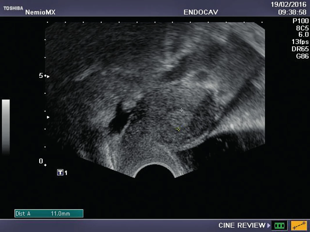 Sekrečně transformované endometrium