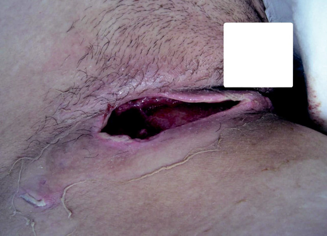 Absces třísla