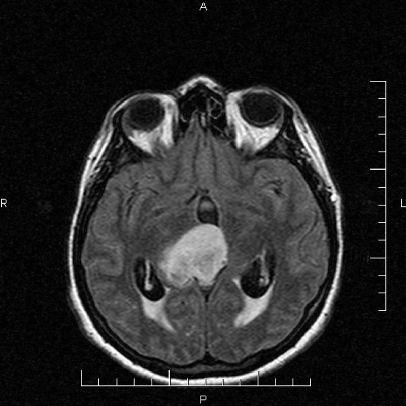Obr. 1. MR T1 vážený obraz s použitím gadolinia s nálezem vs gliálního tumoru talamu.</br> Fig. 1. MR T1W CE showing the suspecting glioma tumor in thalamus. 