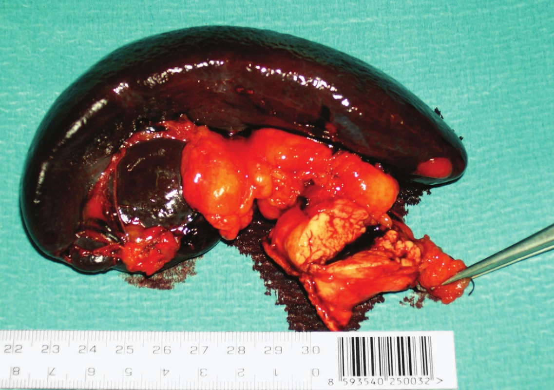 Resekovaná kauda pankreatu se slezinou.
Fig. 4: Resected tail of pancreas with spleen.