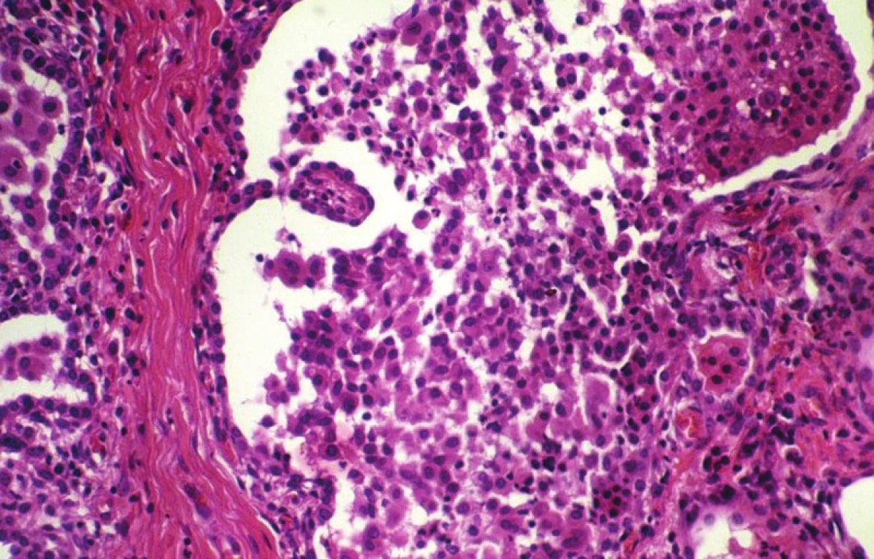Deskvamativní intersticiální pneumonie s četnými makrofágy v alveolárním prostoru. HE, 160krát