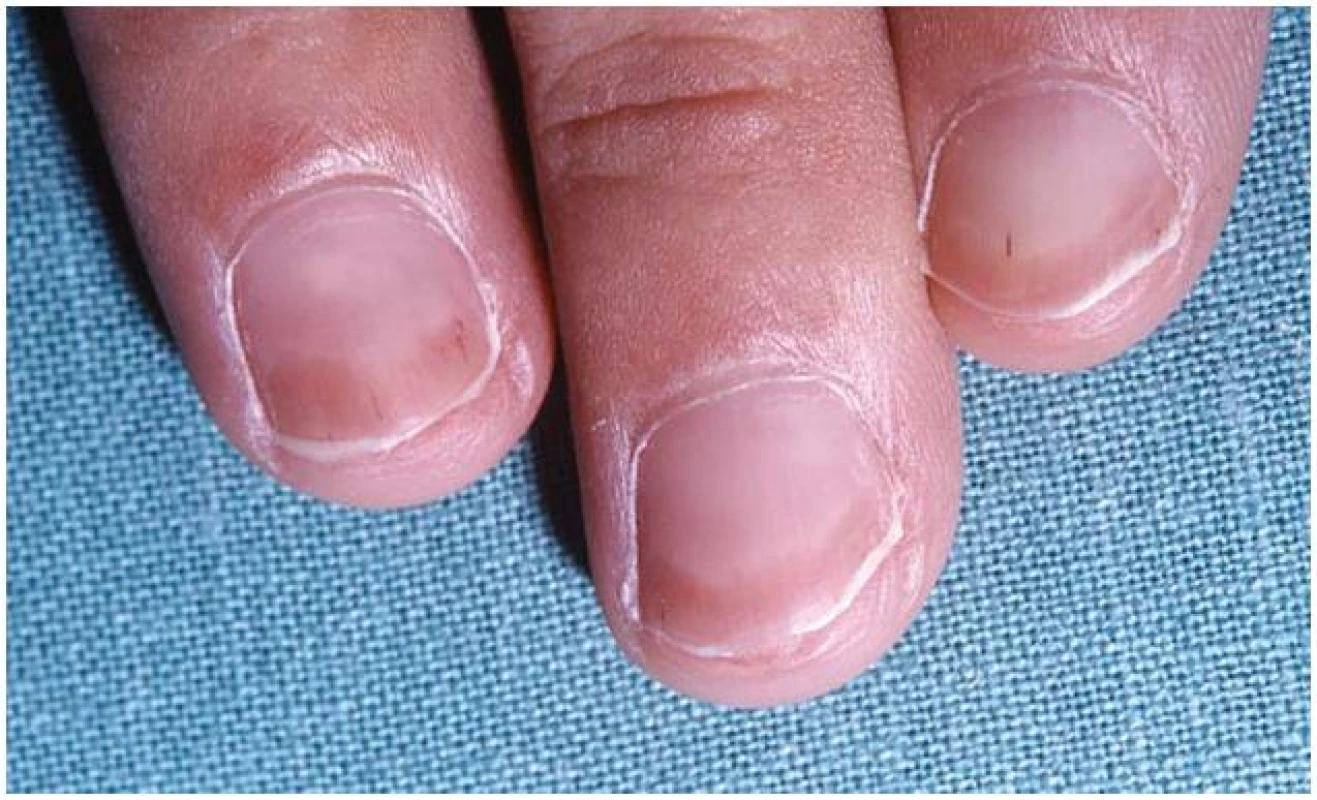 „Half-and-half nail“ a třískovité hemoragie u pacienta s chronickou renální insuficiencí léčeného hemodialýzou